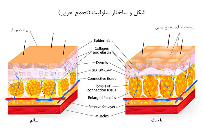 شکل و ساختار سلولیت