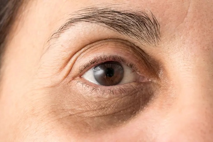 علل تیرگی یا سیاهی اطراف چشم ، دور چشم